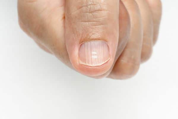 Ridges In Fingernails