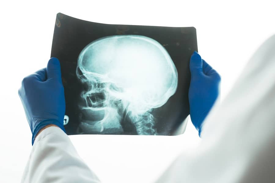 Brain Injury