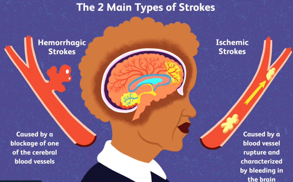 Don't Ignore These Warning Signs of a Stroke