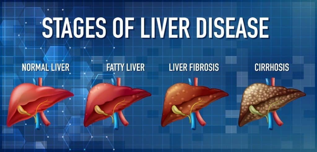 Beware the Silent Epidemic: The Rise of Liver Disease